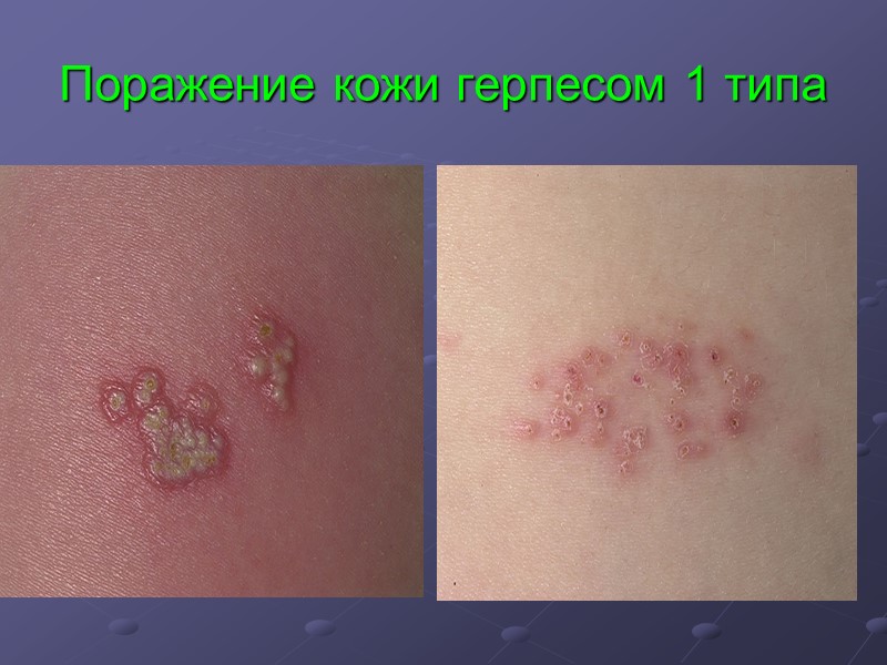 Поражение кожи герпесом 1 типа